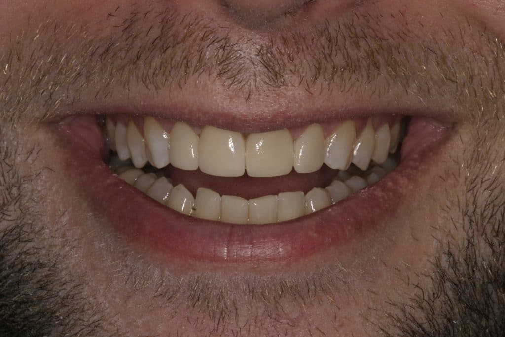 What Steps Should You Take To Protect Your Veneers? St. Louis, MO