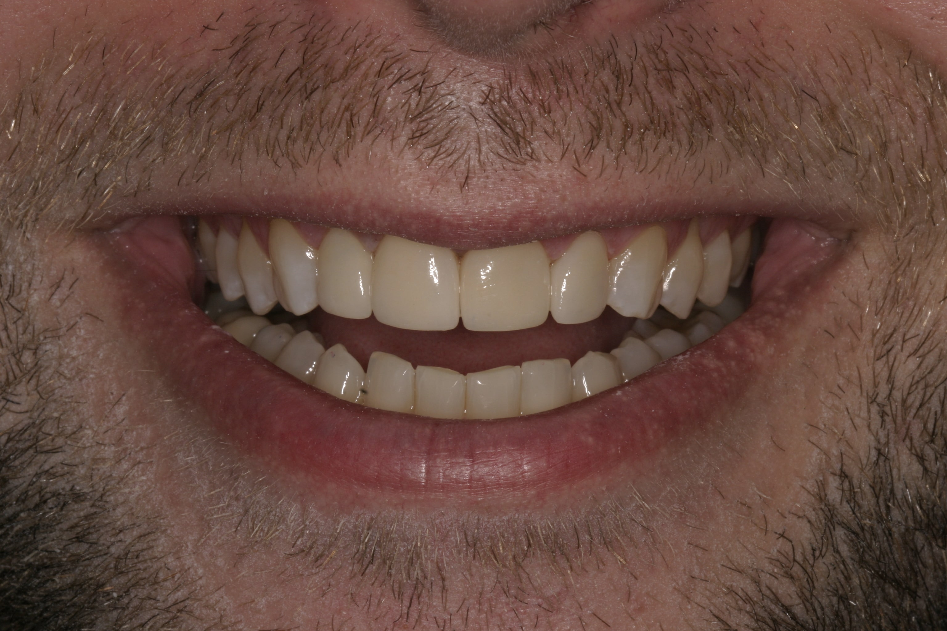 What Steps Should You Take To Protect Your Veneers? St. Louis, MO