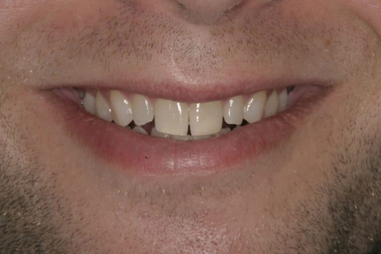 What Steps Should You Take To Protect Your Veneers? St. Louis, MO
